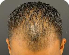 Antes do tratamento de alopecia masculina